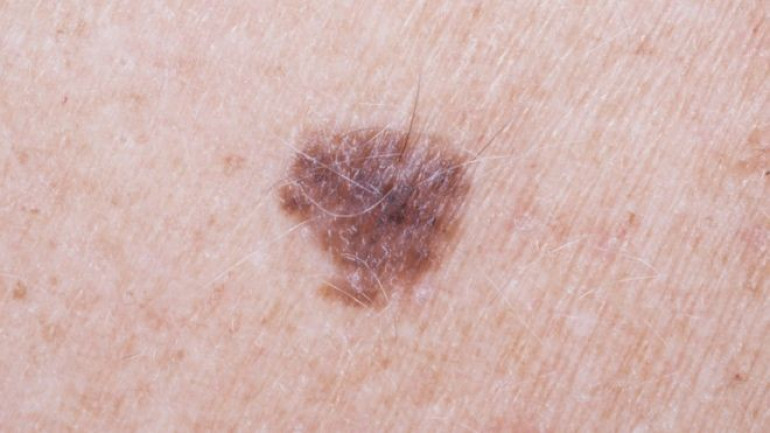 Arm mole count 'predicts skin cancer risk'