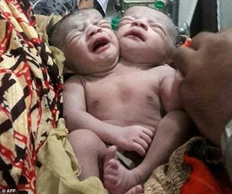 Bangladeshi mother gives birth to conjoined twins who share the same body and organs