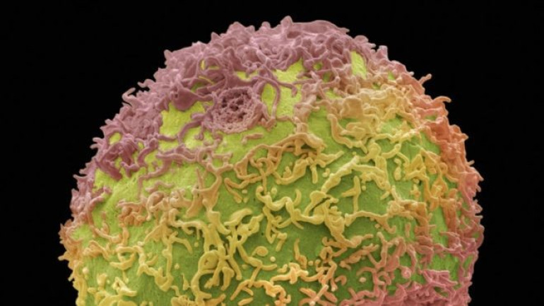 'Suicide' gene therapy kills prostate cancer