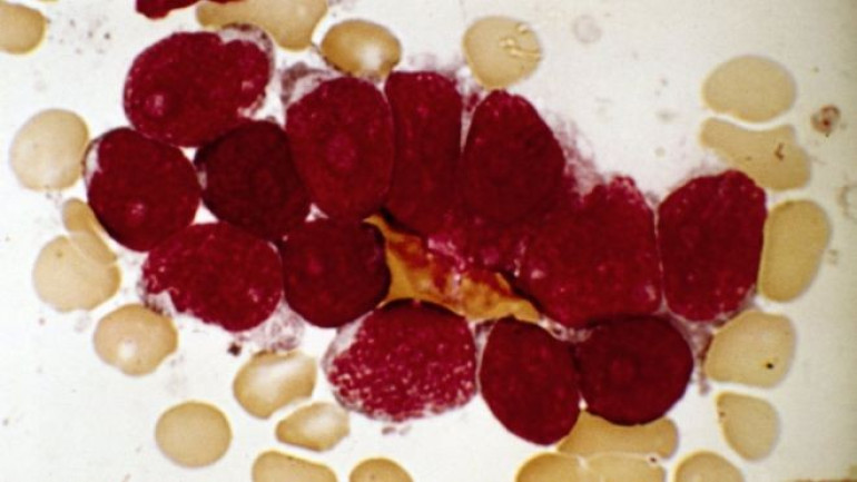 Excitement at new cancer treatment