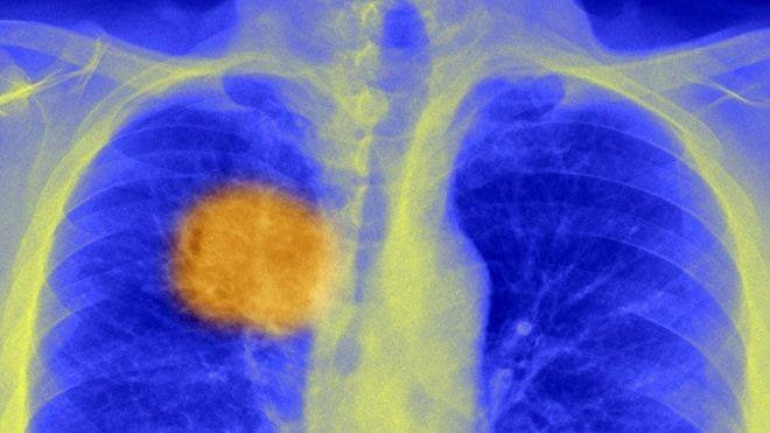 Scientists reveal ‘cancer’s Achilles heel’