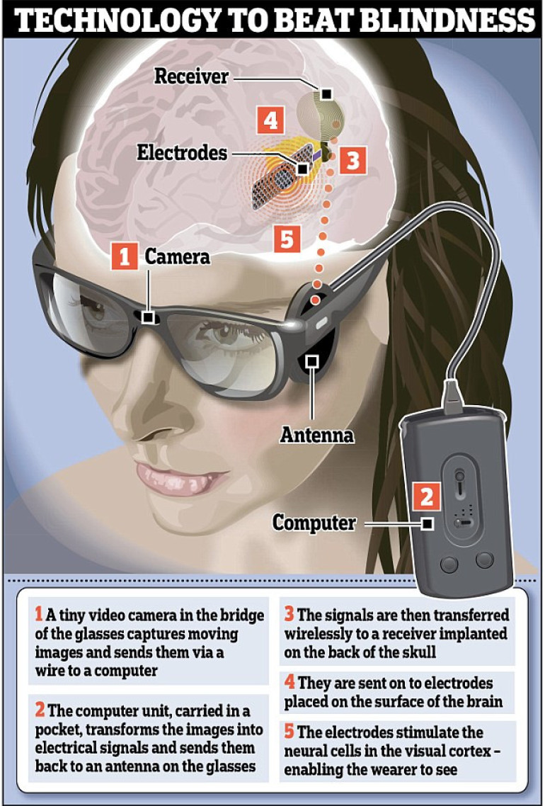 World's first bionic eye to give millions chance of seeing again