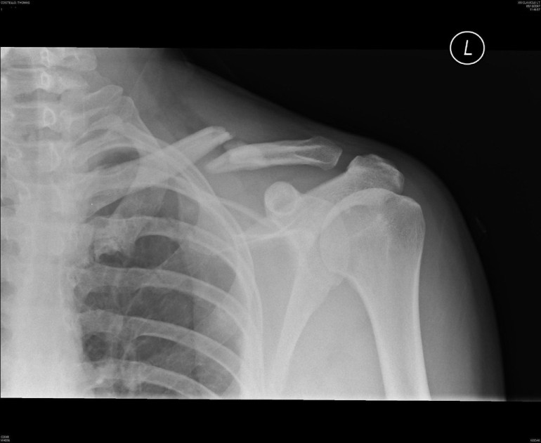 'Pregnancy fluid' reverses ageing bones