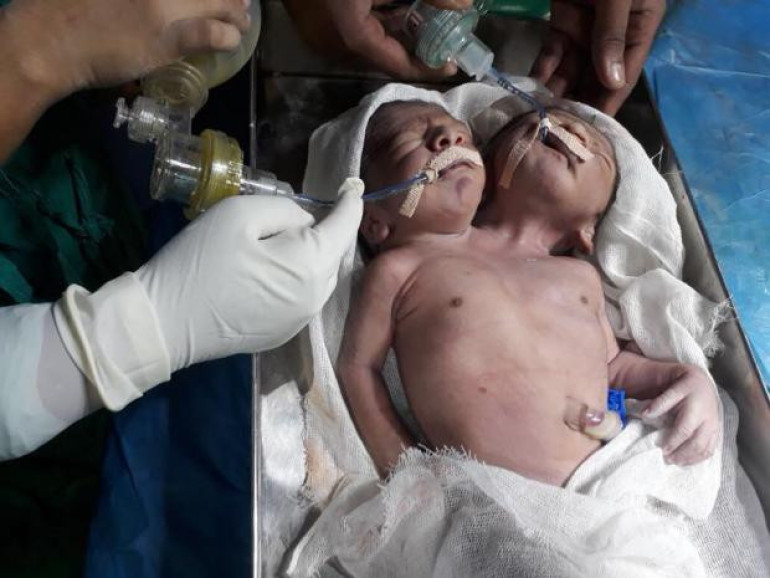 Rare conjoined twins born to Indian tribal couple die day after birth