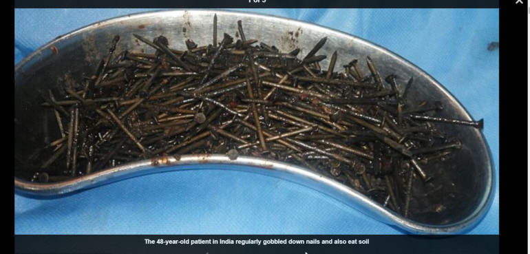639 two inch nails removed from Indian man's stomach without piercing digestive system