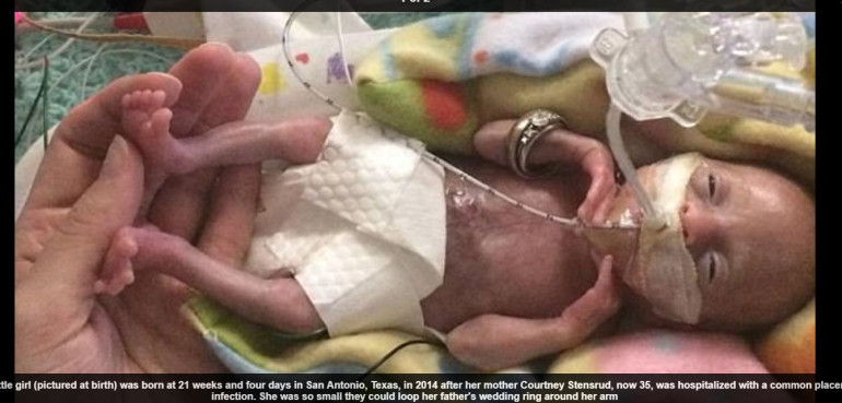 'Most premature baby ever born' thriving 3 years on after emergency labor
 