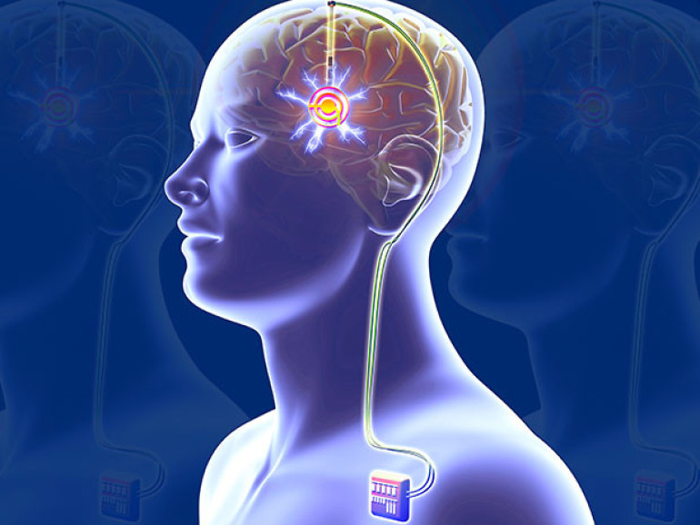 US military funds AI brain implants to handle post-traumatic stress disorders