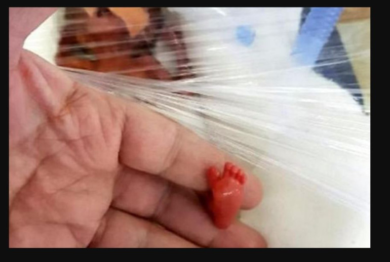 Premature baby born less than a pound ‘smallest ever’ to survive