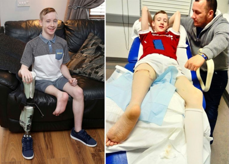 Doctors reattach teenager’s amputated foot backwards to replace cancer-stricken knee-joint