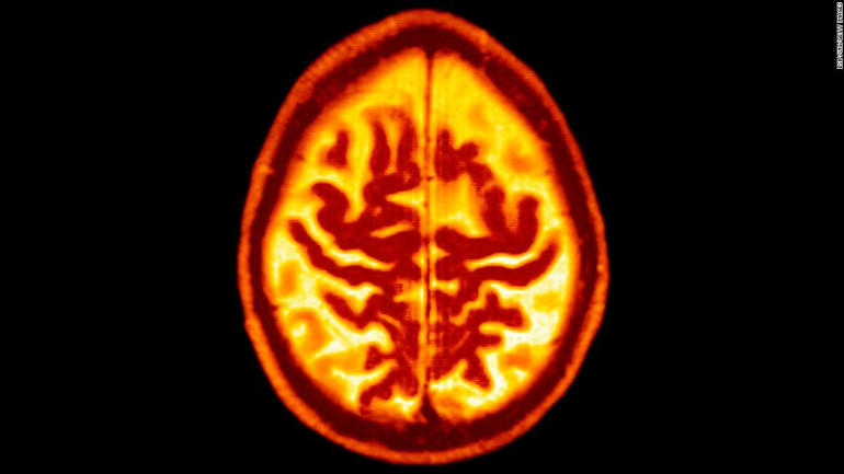 Blood test could detect Alzheimer's up to 16 years before symptoms begin, study finds