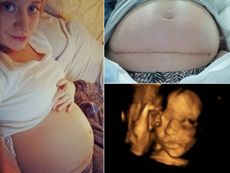 Fetus operated on outside womb in pioneering spinal cord repair surgery