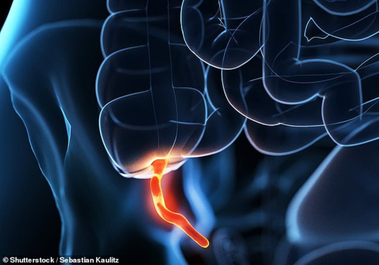 People with removed appendix ‘three times more likely’ to develop Parkinson’s disease