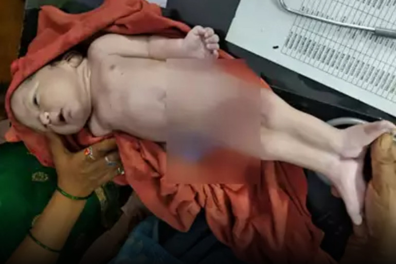 'Mermaid baby' with legs 'joined together' born in India - report