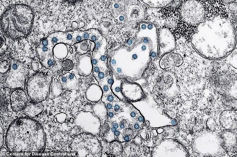 Microscope images reveal how tiny but deadly coronavirus particles invaded the US patient zero's cells