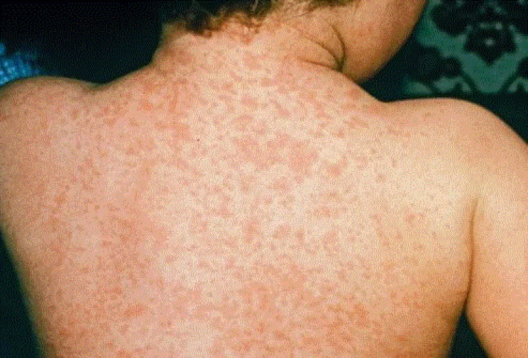 Measles resurgence fear amid coronavirus - BBC