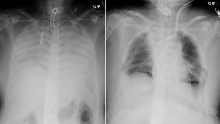 Doctors perform world's first living donor lung transplant to Covid-19 patient in Japan