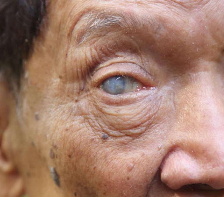 Blind man has sight partly restored after pioneering treatment
 